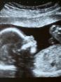 L'échographie et les ultrasons